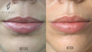 Inyección de labios - Antes y después