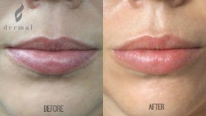 lip job cost