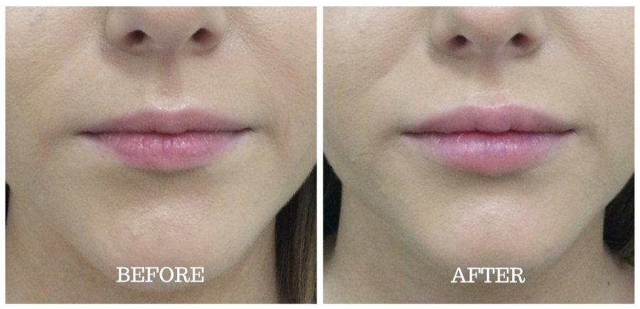 Lèvres - Avant & Après